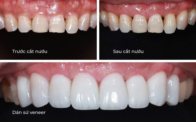 Địa Chỉ Dán Răng Sứ Veneer Tốt Uy Tín Tại TP. HCM Và Bình Thạnh