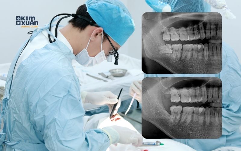 Địa chỉ nhổ răng khôn uy tín tại Bình Thạnh, TP. HCM