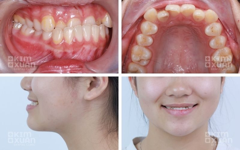 Địa Chỉ Niềng Răng Móm Tốt Uy Tín Tại Tp HCM Và Bình Thạnh