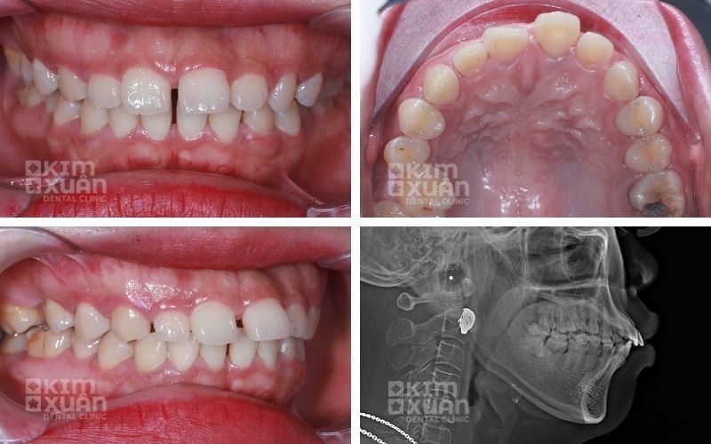 Điều Trị Hô Hàm Tại Nha Khoa Kim Xuân
