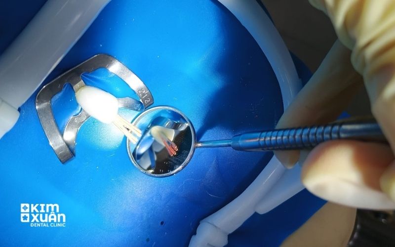 Điều Trị Răng Chết Tủy