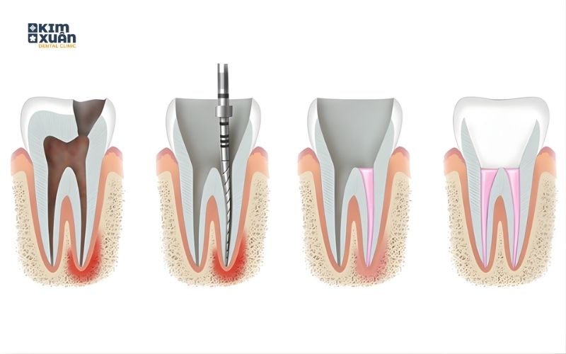 Điều Trị Tủy Có Đau Không