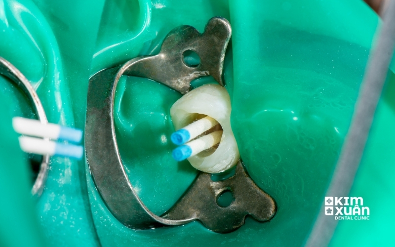 Điều Trị Tủy Giá Bao Nhiêu