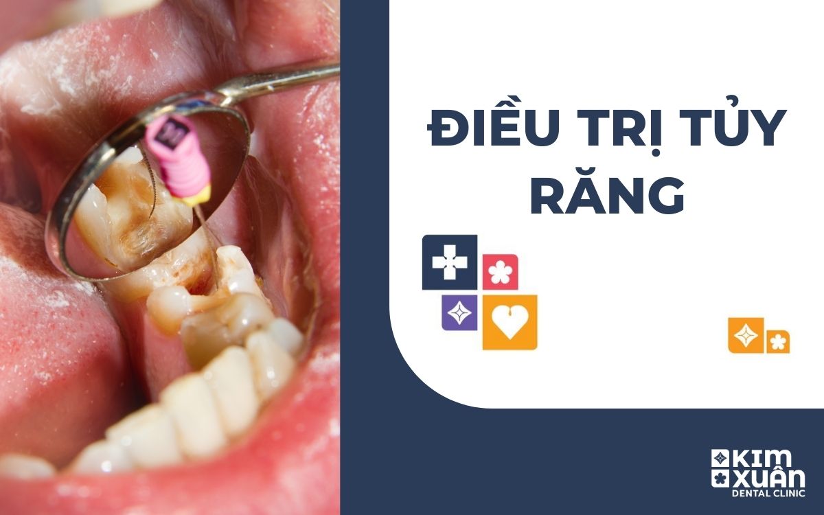 Điều Trị Tủy Răng