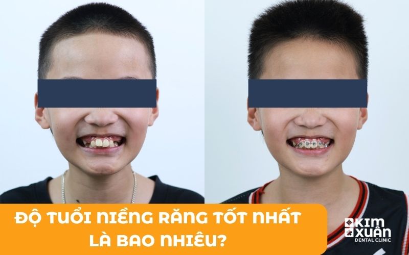 Độ Tuổi Niềng Răng Tốt Nhất