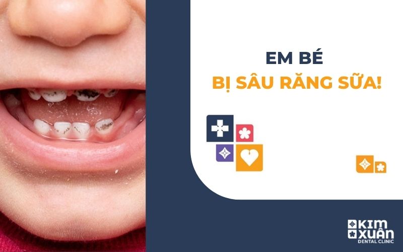 Em Bé Bị Sâu Răng Sữa