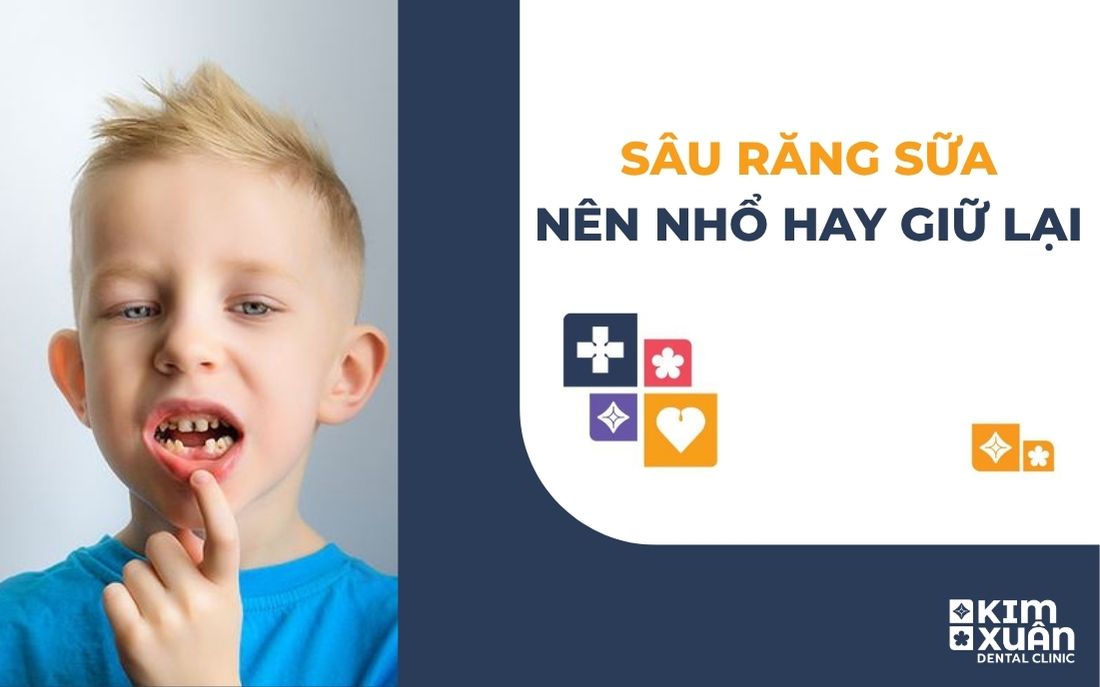 Em Bé Bị Sâu Răng Sữa Nên Nhổ Hay Giữ Lại