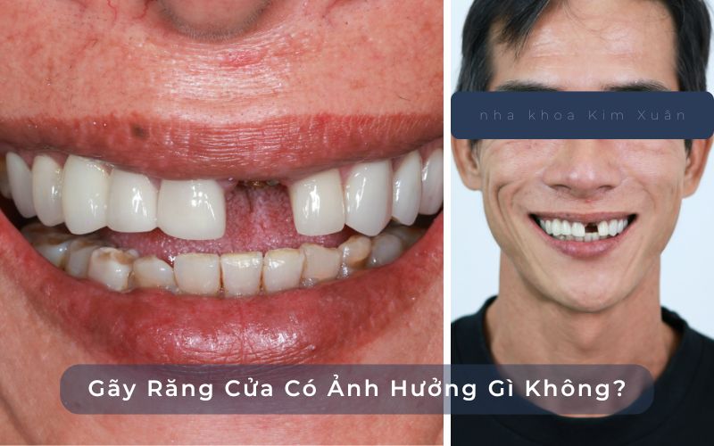 Gãy Răng Cửa Ảnh Hưởng Đến Thẩm Mỹ