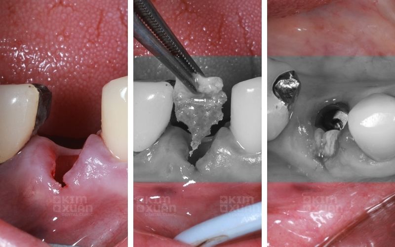 Ghép Xương Khi Trồng Răng Implant Có Đau Không