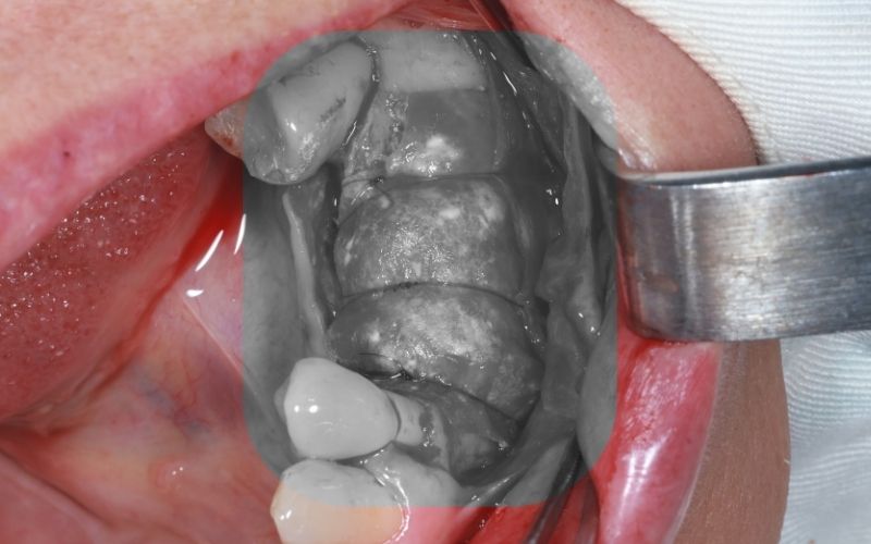 Ghép Xương Răng Có Đau Không