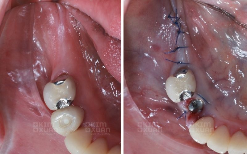 Ghép Xương Răng Tại Nha Khoa Kim Xuân