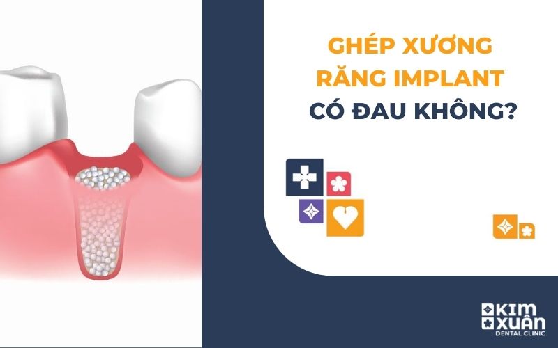 Ghép Xương Răng trong Implant Có Đau Không
