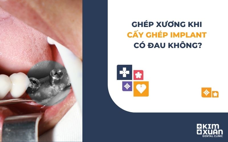 Ghép Xương Trong Implant Có Đau Không