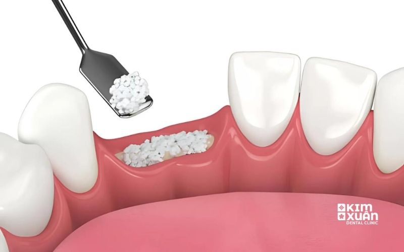 Ghép Xương Trong Implant Là Gì