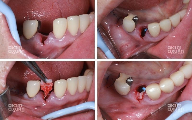 Ghép xương và trồng răng implant tại Nha Khoa Kim Xuân