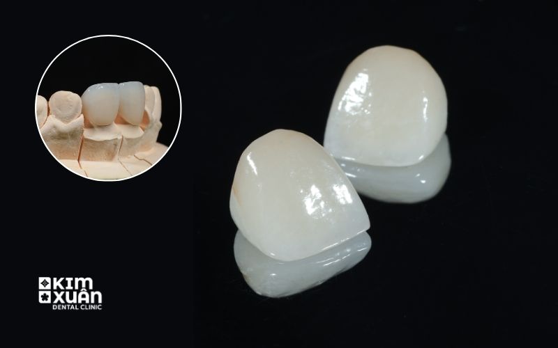 Giá Bọc Răng Toàn Sứ Bao Nhiêu Tiền