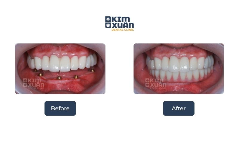Giá Cấy Ghép Implant Bao Nhiêu