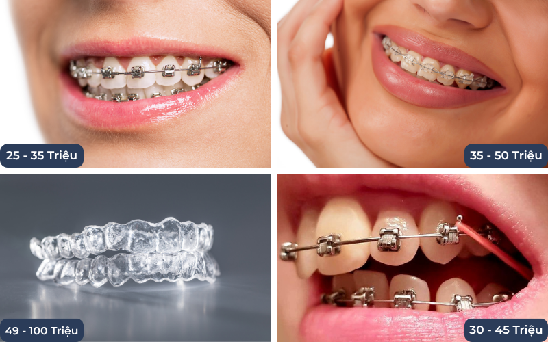 Giá Niềng Răng 20 Tuổi Giá Bao Nhiêu Tiền