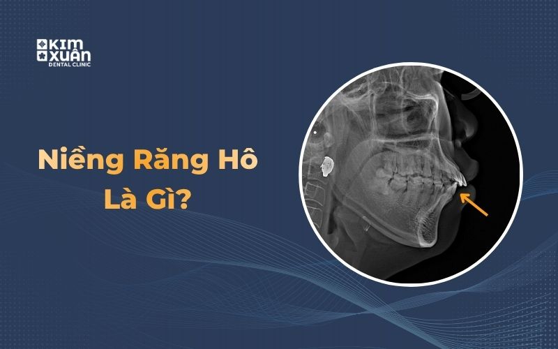 Hình ảnh niềng răng hô và phim X-quang chỉnh nha