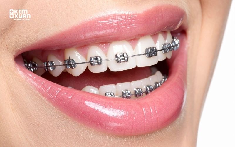 Giá Niềng Răng Mắc Cài Bao Nhiêu Tiền