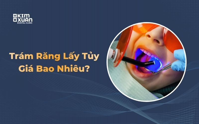 Giá trám răng lấy tủy giá bao nhiêu tiền