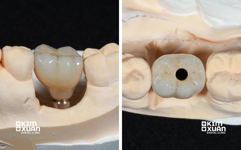 Giá Trồng Răng Implant Đơn Lẻ Cho Người Lớn Tuổi Bao Nhiêu Tiền Năm 2026