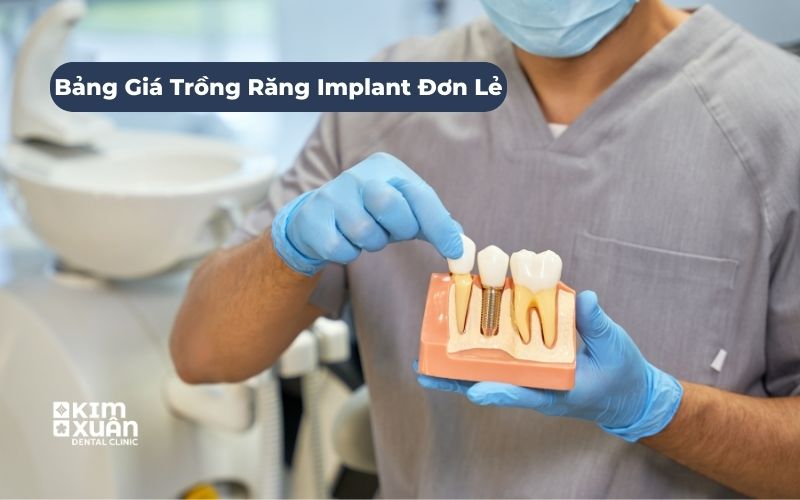 Giá Cấy Ghép Implant Đơn Lẻ