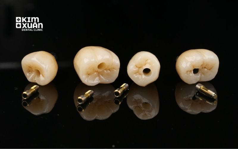 Giá Trồng Răng Vinh Viễn Trên Implant Bao Nhiêu