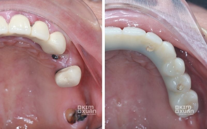 Giải Pháp Trồng Răng Implant Khi Bị Tiêu Xương Hàm