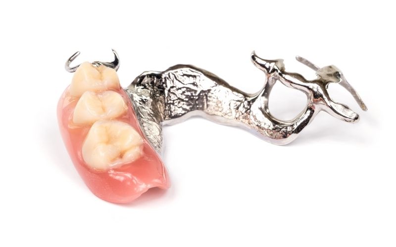 Hàm giả tháo lắp khung kim loại dùng để phục hồi răng mất.