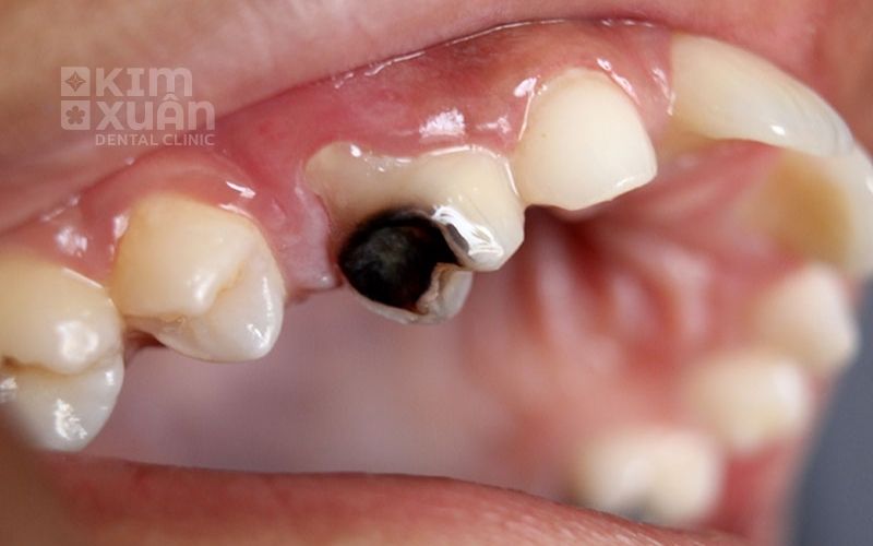 Hậu Quả Khi Không Chữa Trị Răng Hàm Và Răng Cấm Khi Đau Nhức