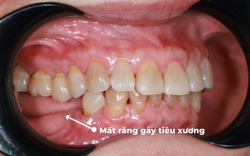 Hậu Quả Mất Răng Số 6