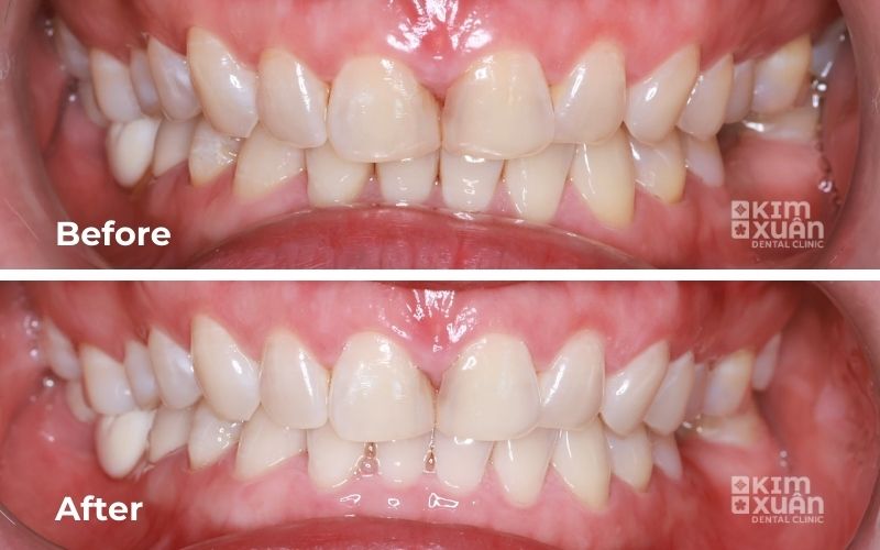 Kết quả tẩy trắng răng trước và sau điều trị tại Nha khoa Kim Xuân