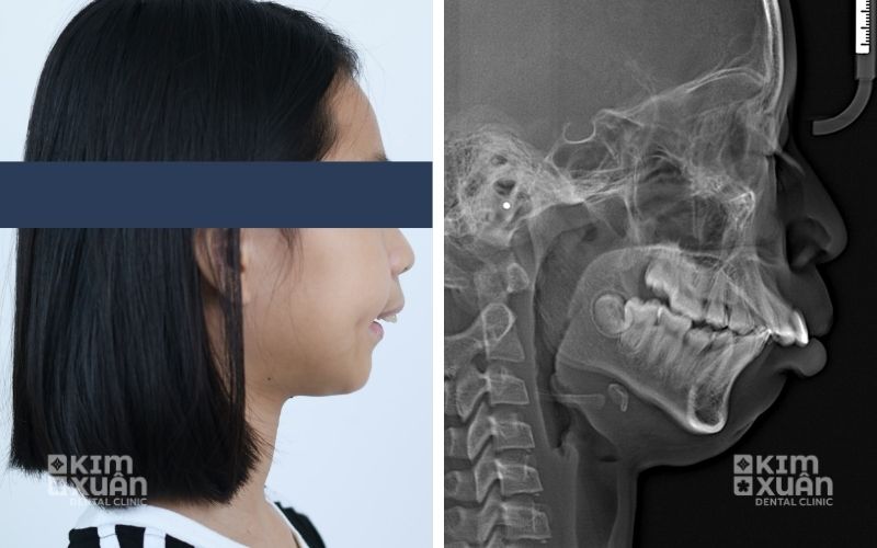 Hình Ảnh Bệnh Nhân Bị Hô Hàm Trên