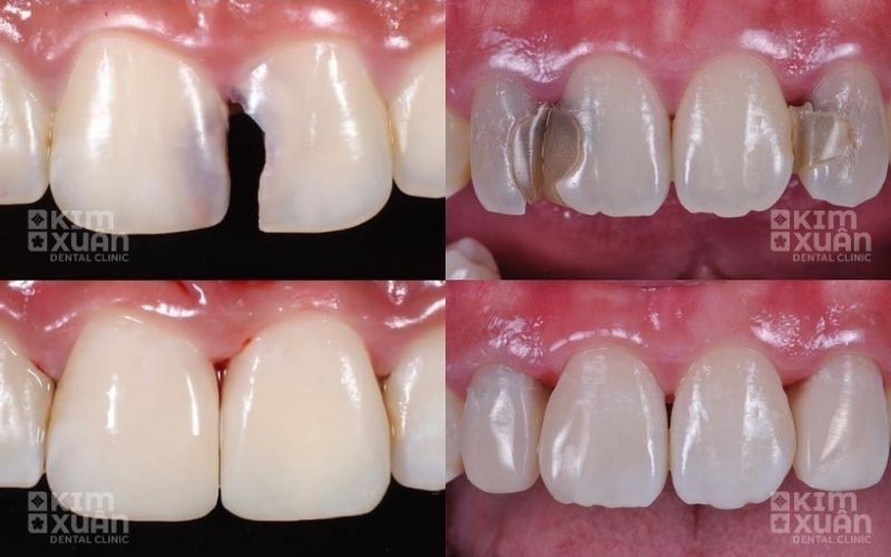 Hình Ảnh Bị Sâu Răng Cửa Trước Và Sau Khi Điều Trị
