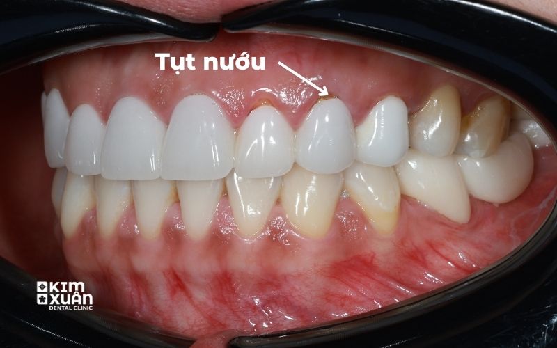 Hình Ảnh Bọc Răng Sứ Bị Tụt Nướu