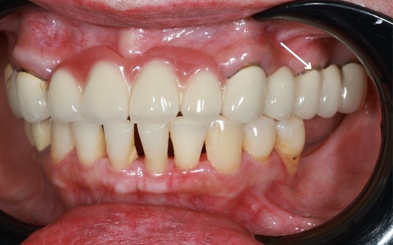 Hình Ảnh Bọc Răng Sứ Bị Viêm Nướu Đau Nhức