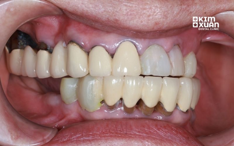 Hình Ảnh Bọc Răng Sứ Kim Loại Bị Viêm Lợi