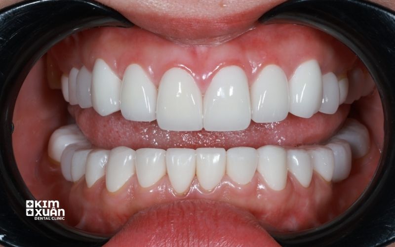 Hình Ảnh Bọc Răng Sứ Nguyên Hàm