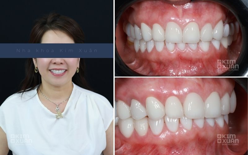 Hình Ảnh Bọc Răng Sứ Nguyên Hàm Tại Nha Khoa Kim Xuân