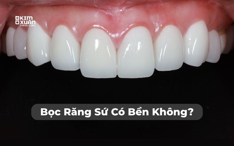 Hình Ảnh Bọc Răng Sứ Tại Nha Khoa Kim Xuân