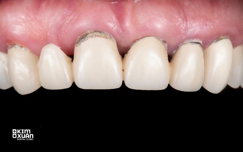 Hình Ảnh Bọc Răng Sứ Titan Bị Đen Viền Nướu
