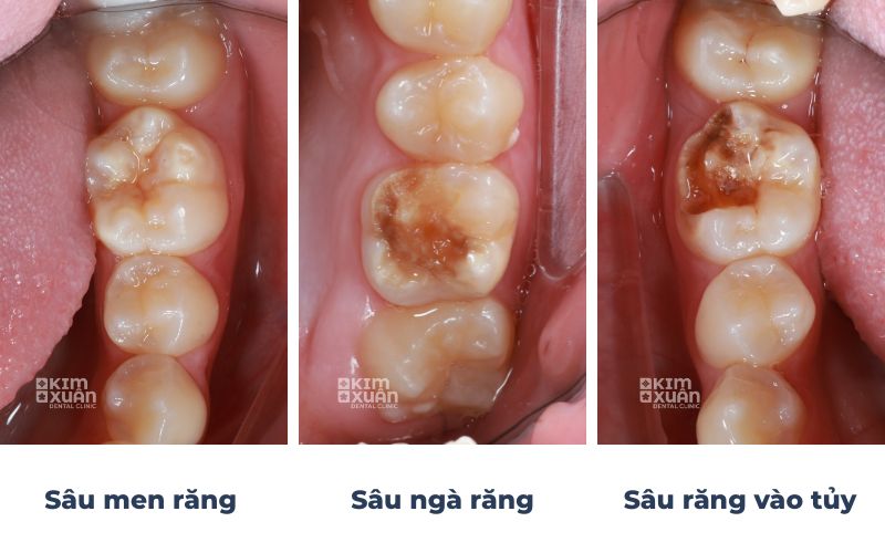 Hình ảnh các mức độ sâu răng từ nhẹ đến nặng