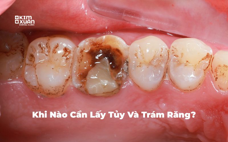 Hình ảnh cần phải lấy tủy và trám răng