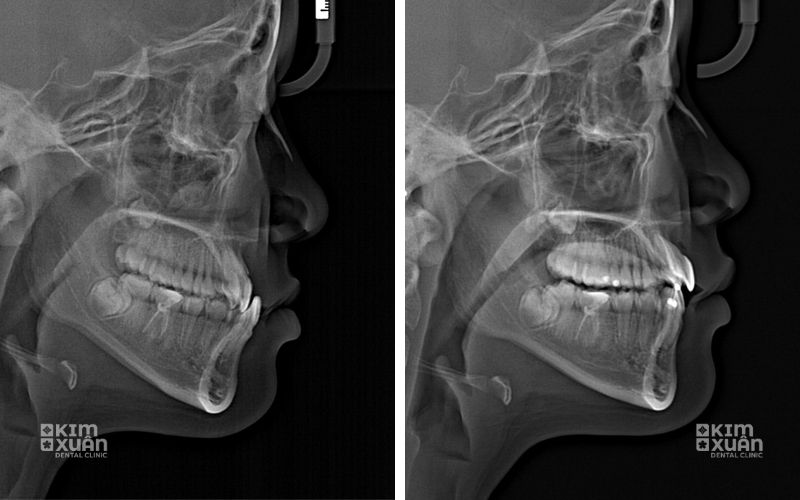 Hình Ảnh Chụp Phim Trước Và Sau Khi Niềng Răng Móm