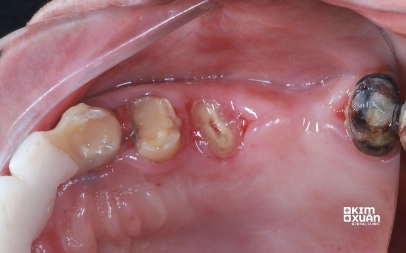 Hình Ảnh Còn Chân Răng