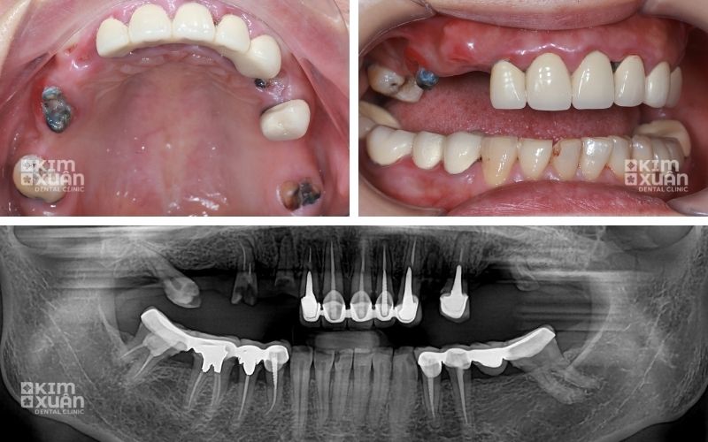 Hình Ảnh Còn Chân Răng Bị Tiêu Xương Hàm