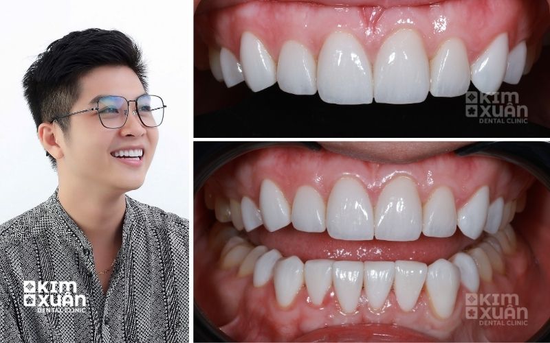 Hình Ảnh Dán Sứ Veneer Nguyên Hàm