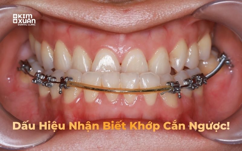 Hình ảnh dấu hiệu khớp cắn ngươc