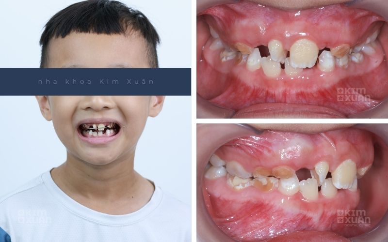 Hình Ảnh Dấu Hiệu Nên Niềng Răng Cho Trẻ